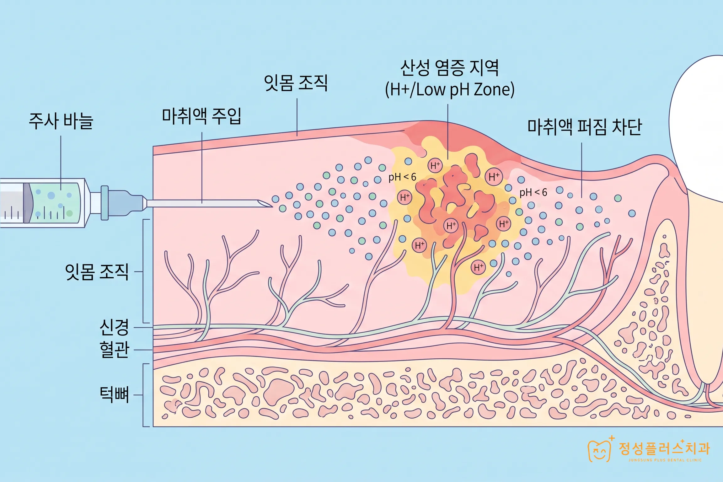 부천 고강동 사랑니 주위염, 잇몸 붓고 아플 때 당일에 바로 뽑을 수 있을까?