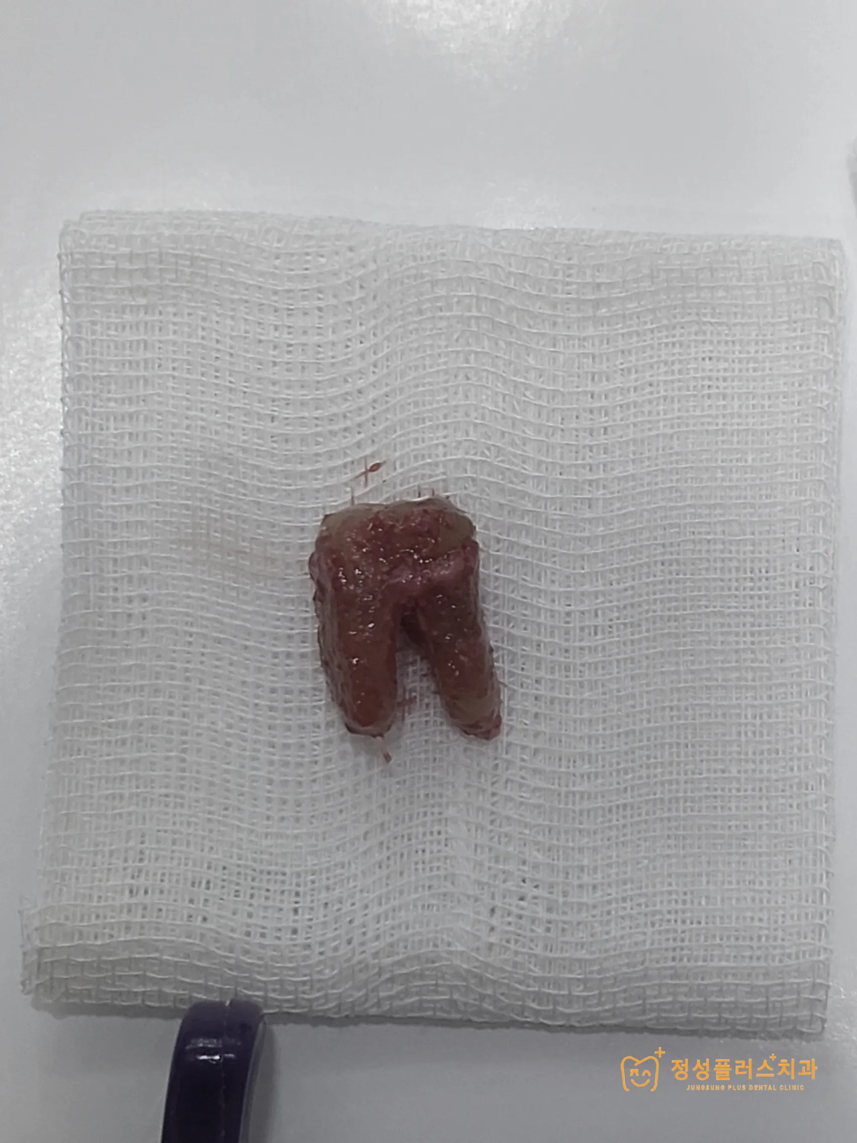 화곡 치과, 신경치료 후 다시 아프다면? 통증 재발 원인과 해결법